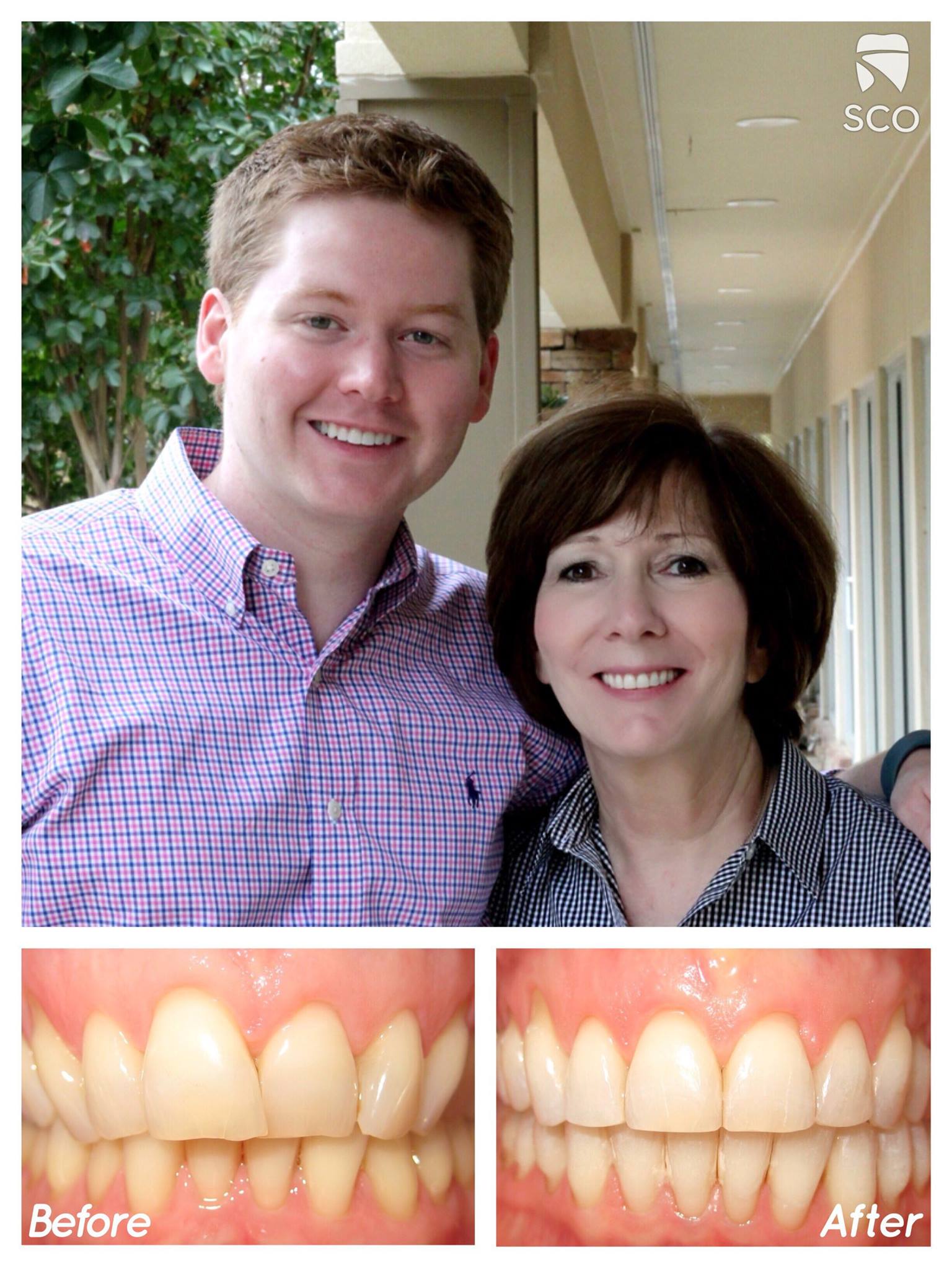 adult braces before and after | Memphis orthodontist | Dr. Kyle Fagala