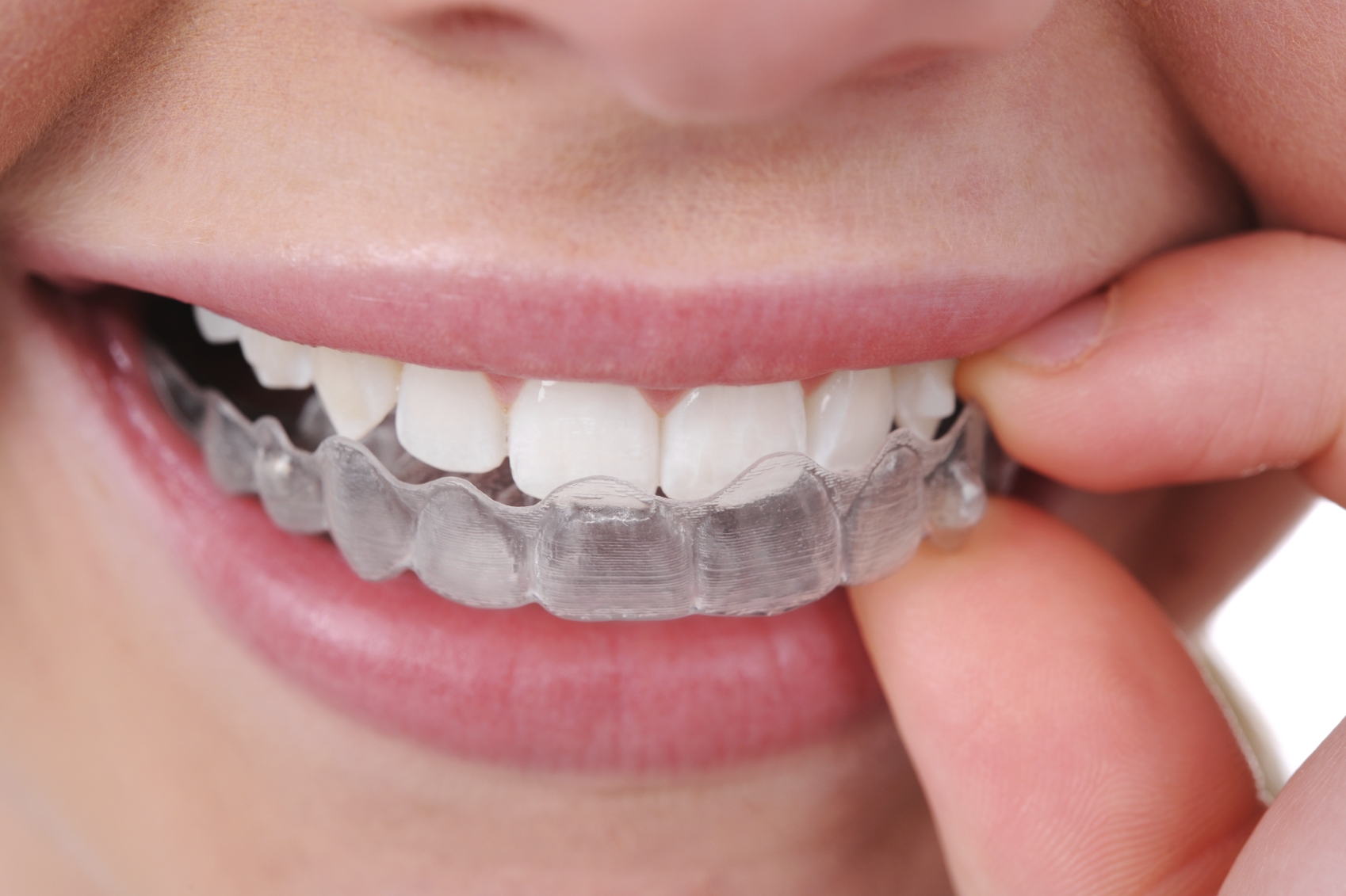 Memphis Invisalign | Saddle Creek Orthodontics | Invisalign Memphis