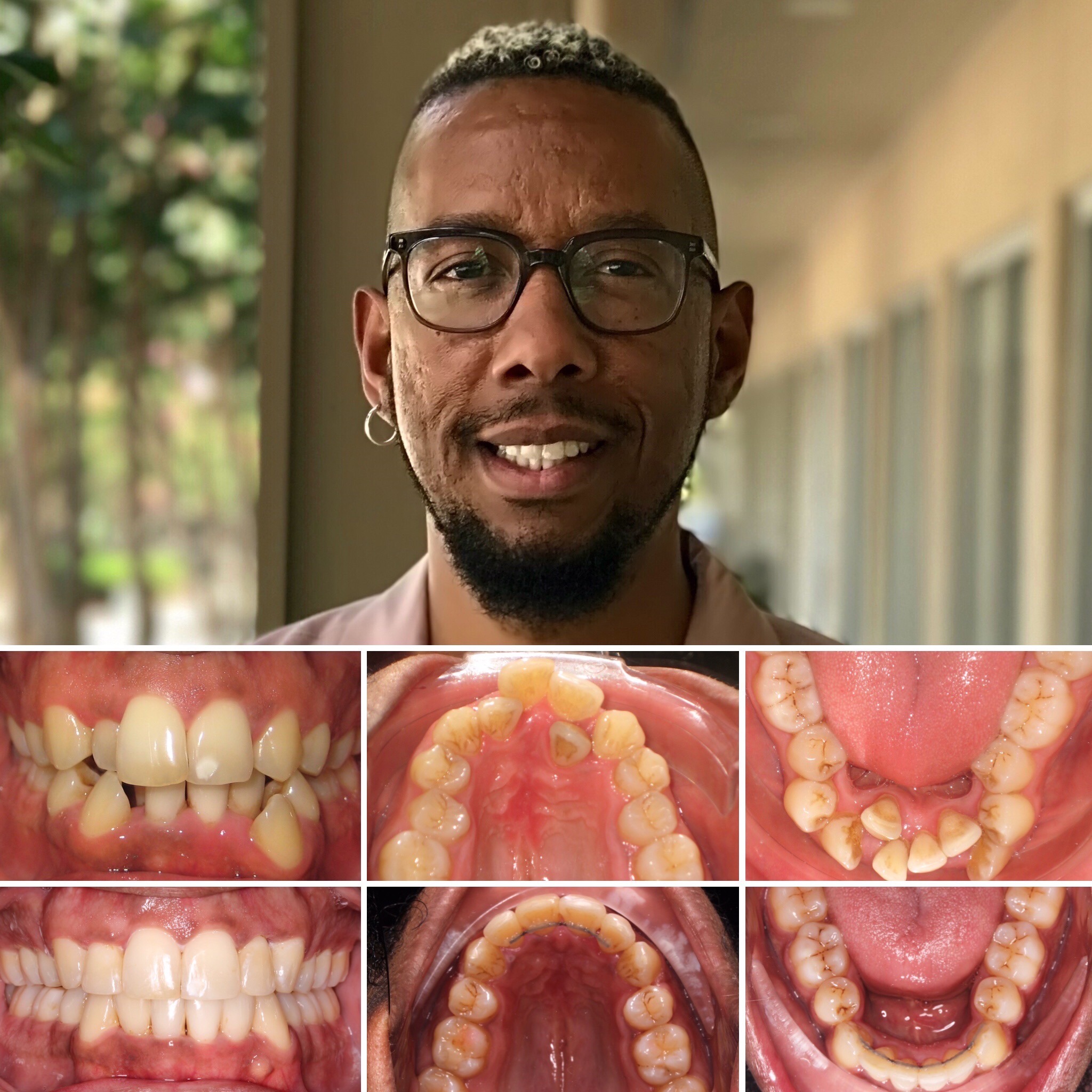 patient Lee before and after photo