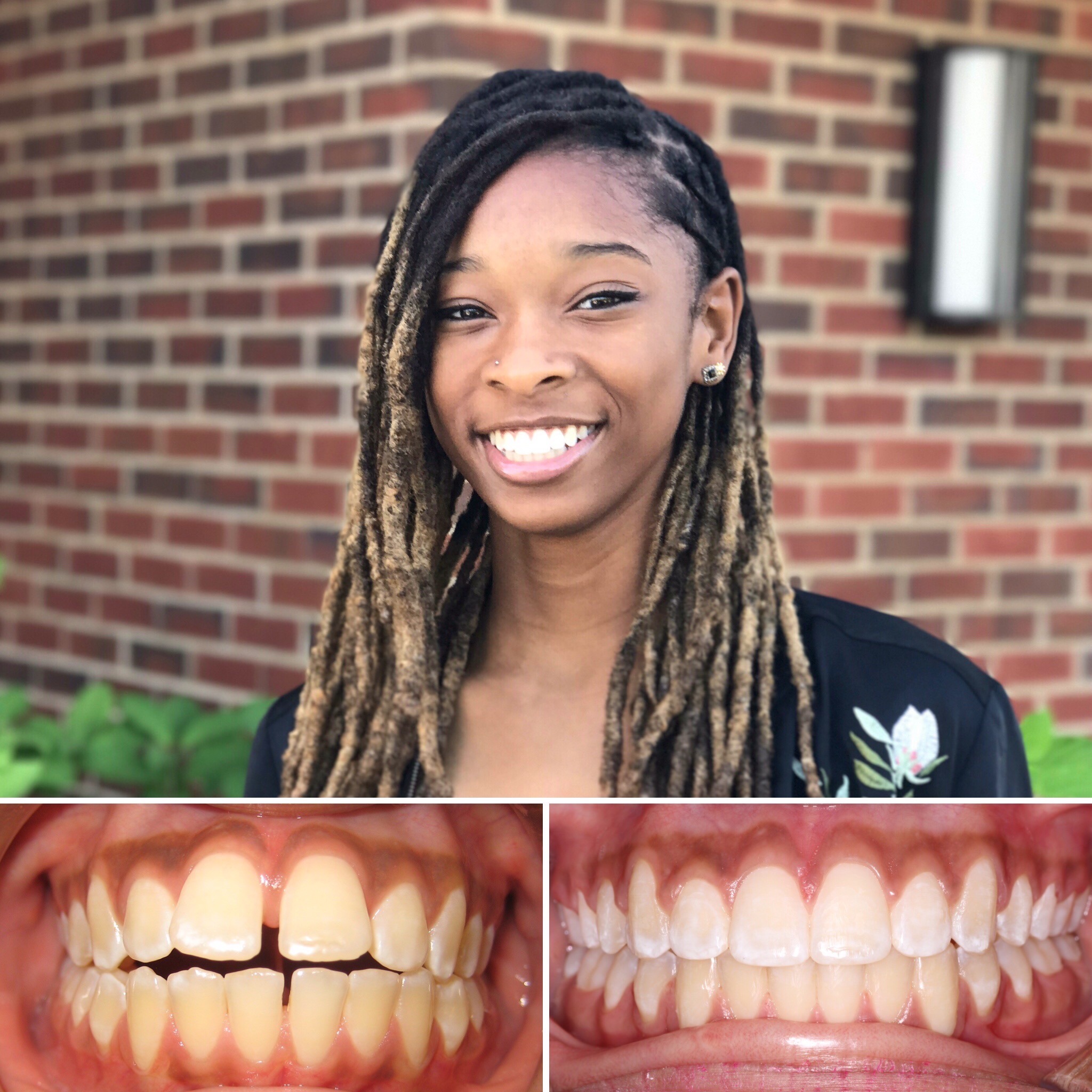 patient  before and after photo