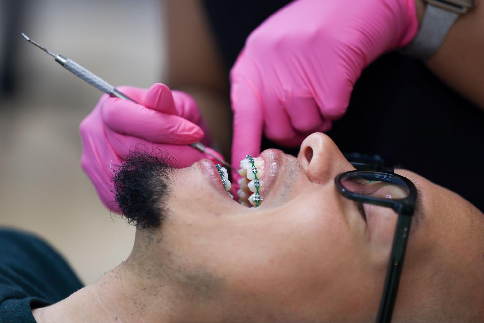 How Do You Prevent Stains While Wearing Braces?