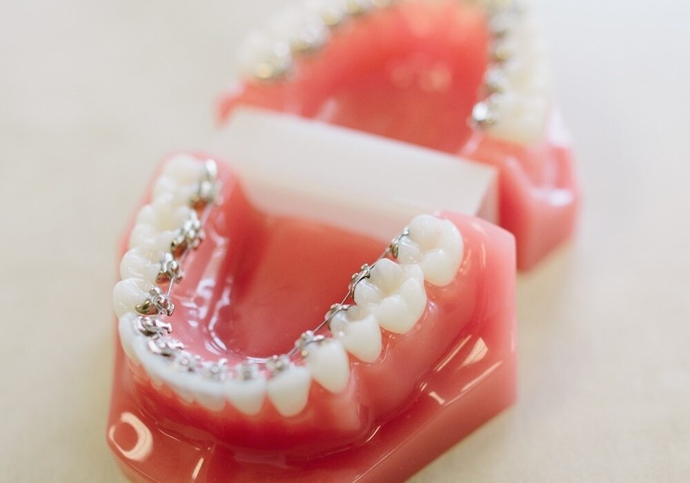 Lingual Braces